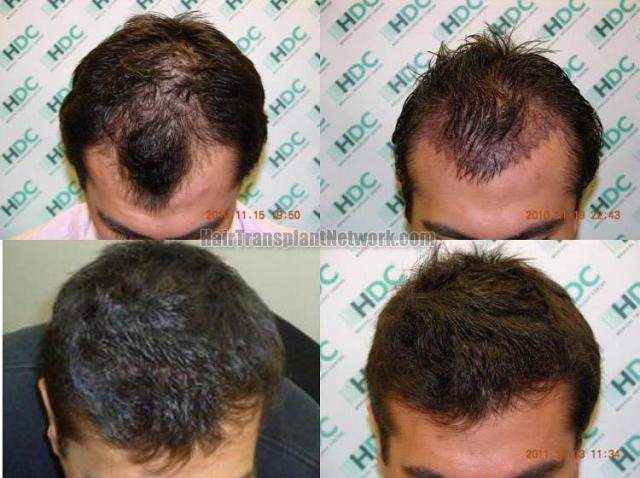 Top view before and after hair restoration results