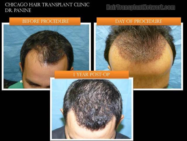 Top view before and after hair restoration results