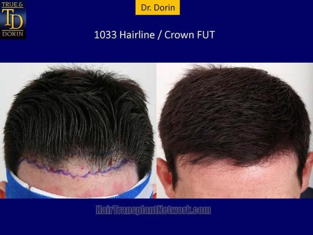 Hair transplantation surgery before and after pictures