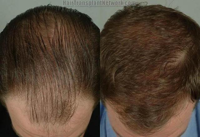 Hair restoration procedure before and after results