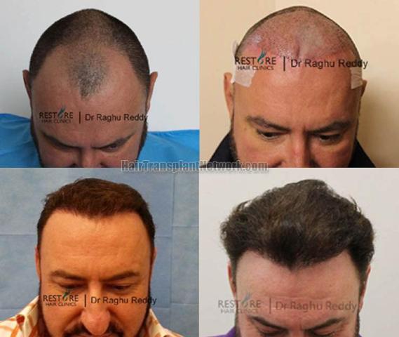 Hair restoration procedure before and after results