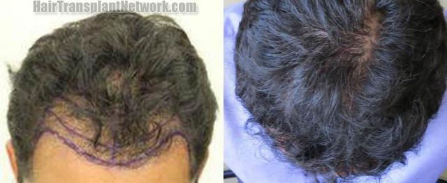 Hair transplantation surgery before and after images