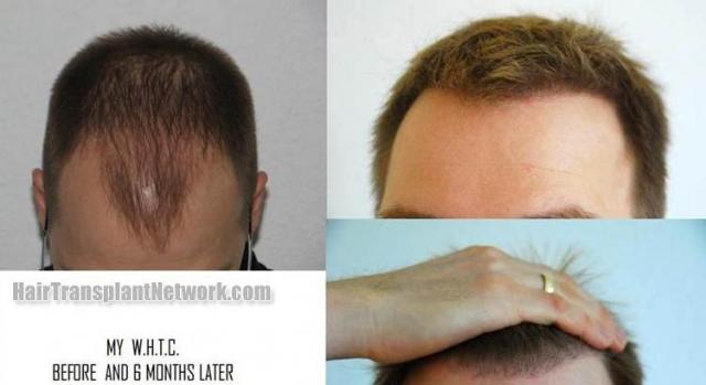 Hair restoration procedure before and after results