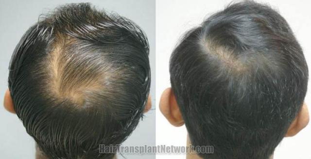 Back view before and after hair restoration procedure