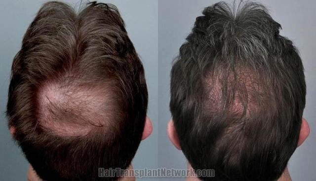 Hair transplantation surgery before and after pictures