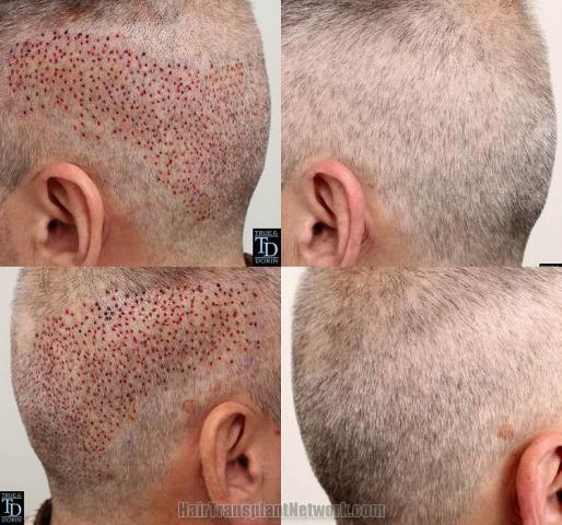 Hair transplantation surgery before and after photos