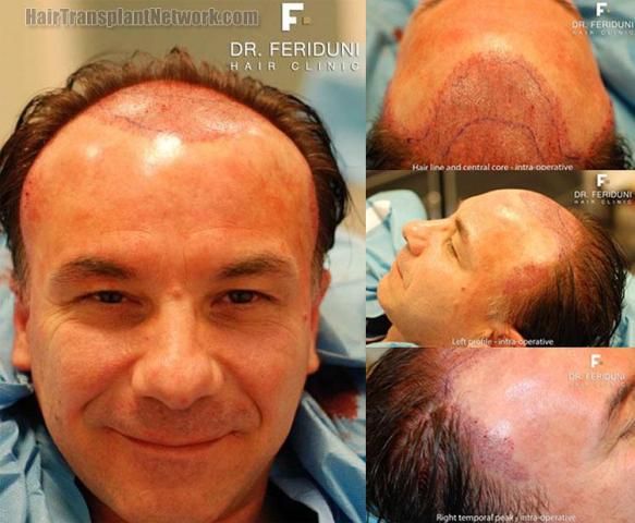 Hair transplant procedure intraoperative photos