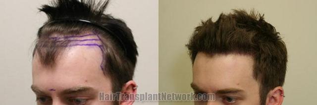 Before and after hair transplant procedure images