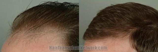 Hair transplantation surgery before and after images