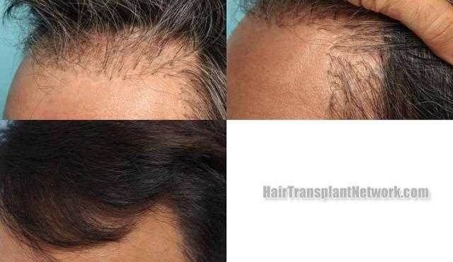 Hair transplantation surgery before and after pictures