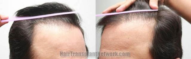 Hair transplantation surgery before and after pictures