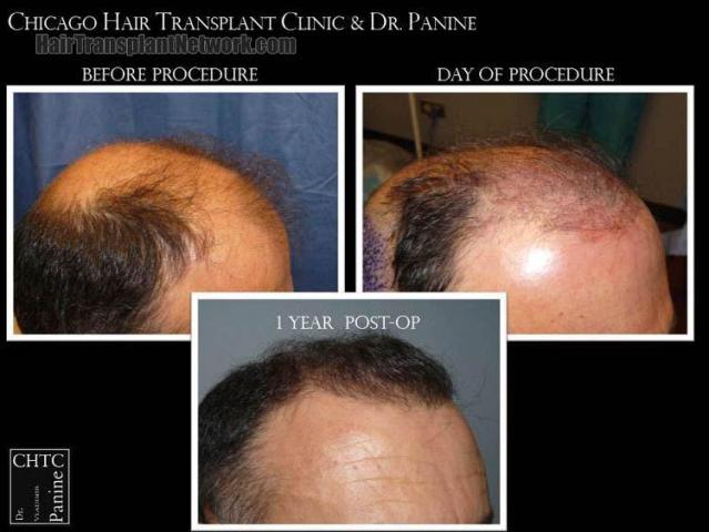 Hair transplantation surgery before and after photos