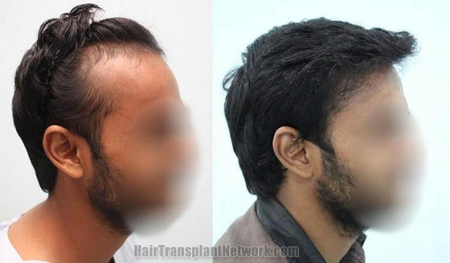 Hair transplantation surgery before and after images