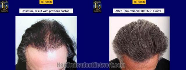 Hair restoration procedure before and after results