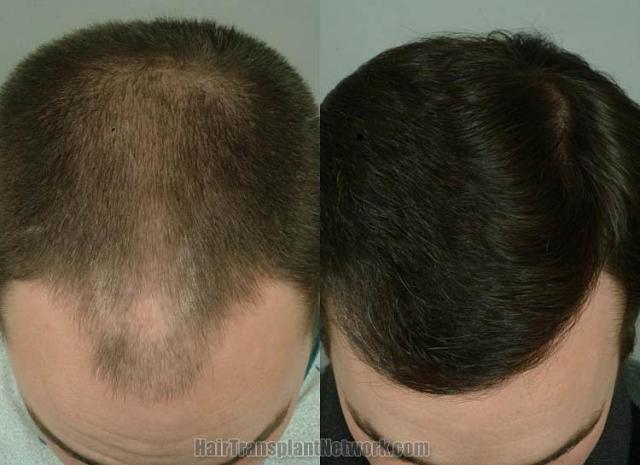 Hair transplantation surgery before and after photos