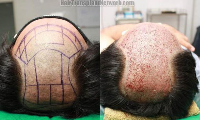 Hair restoration procedure before and after pictures