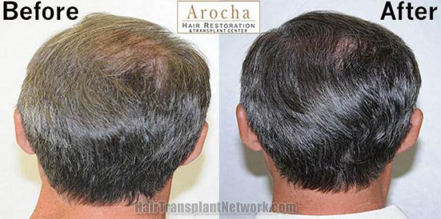 Hair transplantation surgery before and after pictures