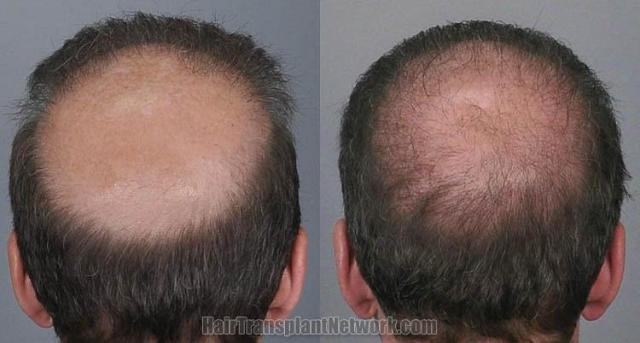 Hair transplantation surgery before and after pictures