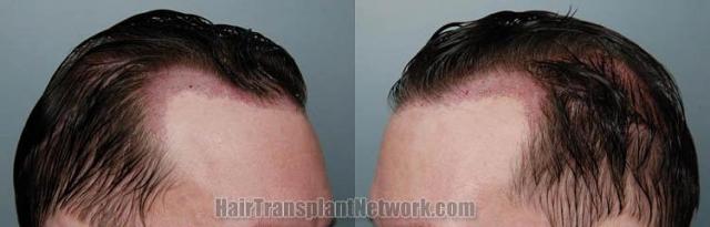 Hair restoration procedure immediate postoperative