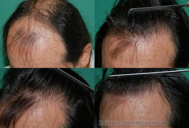 Before and after surgical hair restoration images