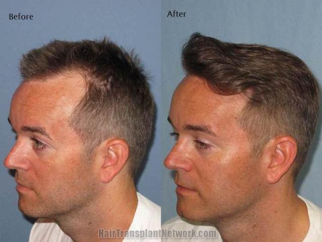 Hair transplantation surgery before and after images