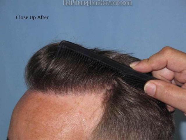 Hair restoration surgery before and after images