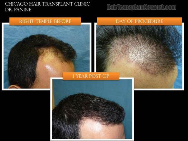 Hair restoration procedure before and after results