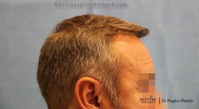 Hair transplantation surgery before and after photos