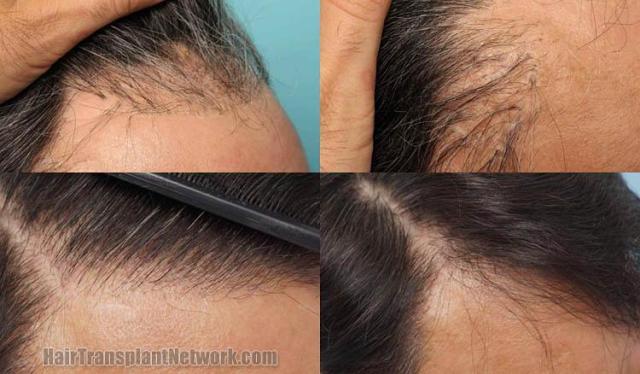 Hair transplantation surgery before and after images