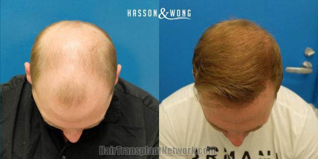 Top view before and after hair restoration results