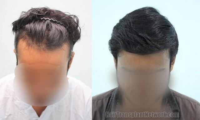 Hair restoration procedure before and after results