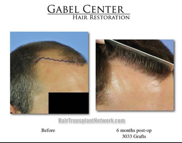 Hair replacement surgery before and after images