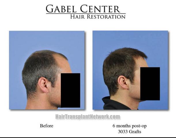 Hair restoration procedure before and after results