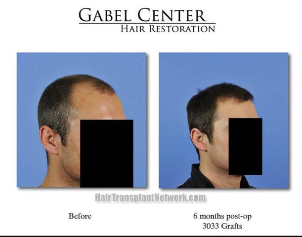 Before and after surgical hair restoration images