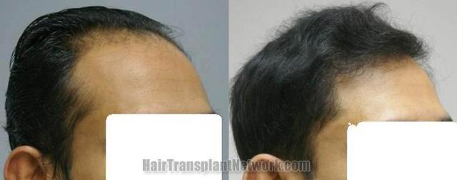 Hair transplant procedure before and after images