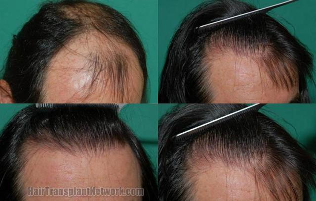 Hair transplantation surgery before and after photos