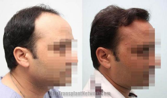 Hair transplantation surgery before and after images