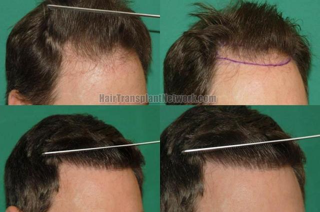 Hair transplantation surgery before and after images