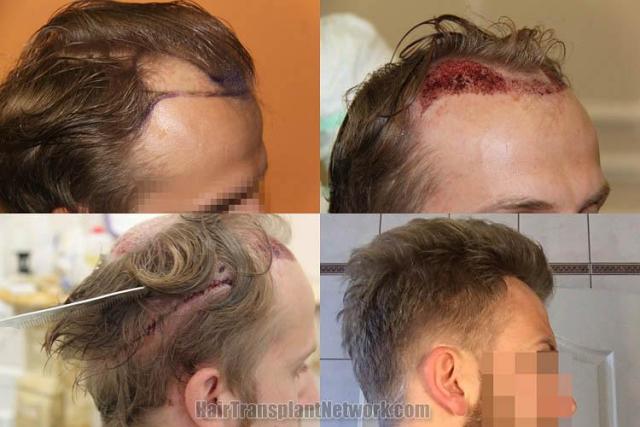 Hair transplantation surgery before and after images