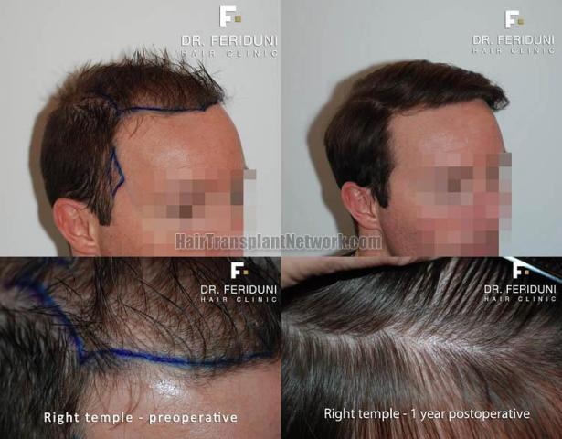 Hair transplantation surgery before and after images