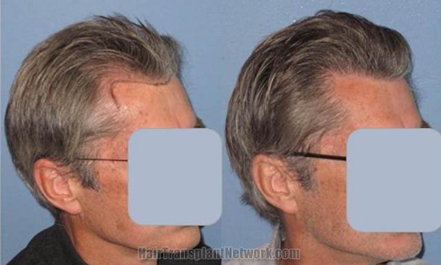 Hair transplantation repair surgery before and after images