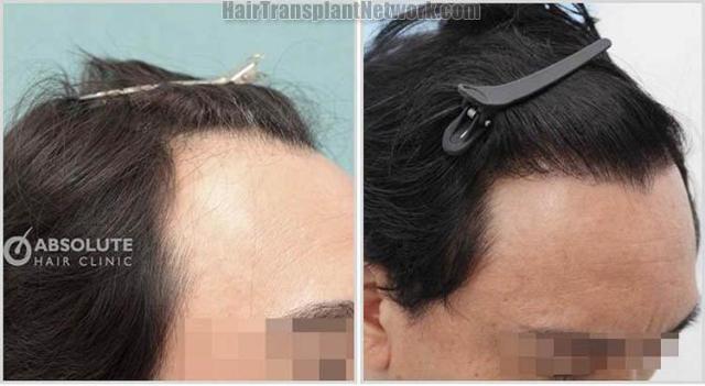 Hair transplantation surgery before and after images