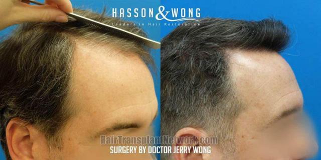 Hair restoration procedure before and after result images