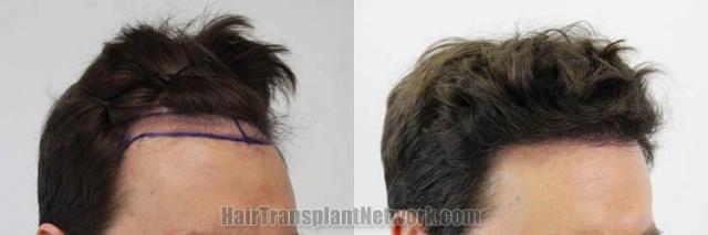 Hair transplantation surgery before and after pictures