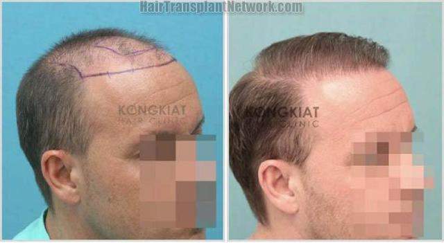 Hair restoration procedure before and after results