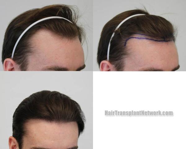 Hair transplantation procedure before and after results