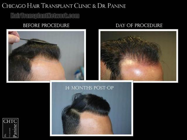 Hair restoration procedure after result images