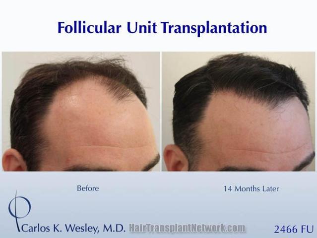 Hair restoration procedure after result images