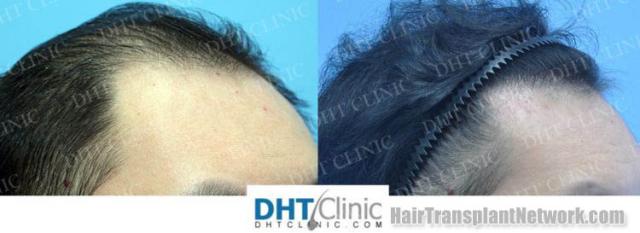 Hair transplantation procedure before and after results