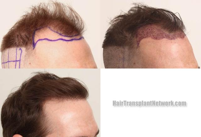 Hair transplantation procedure before and after results